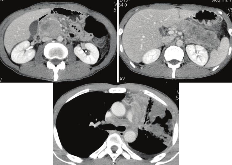 130 THAI J GASTROENTEROL 2016 Imaging of The Pancrease Axial views of post contrast CT show a large fluid collection containing gas of the pancreatic head and body, and minimal viable tissue of the