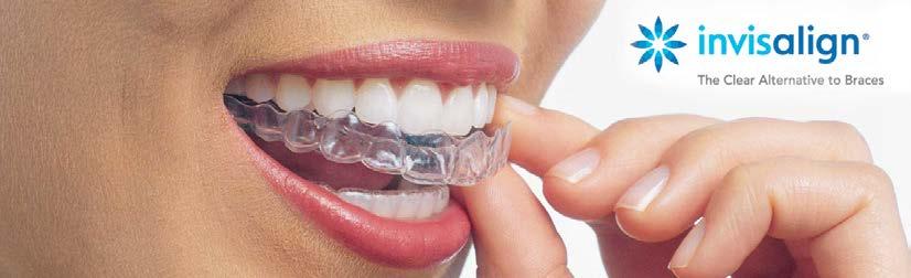 Invisalign Straighten your teeth without anyone knowing Invisalign uses a series of clear, plastic aligners to gradually shift your teeth into their desired position.