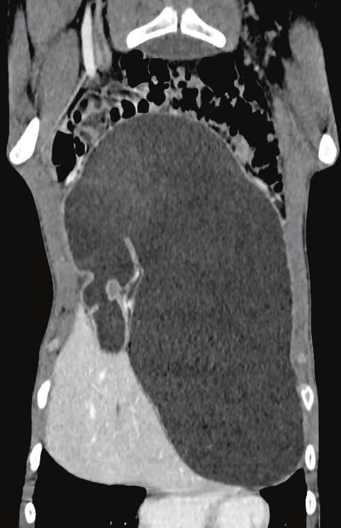 Figure 2: Coronal CT section demonstrating gross distension of the stomach. concern, and so the patient underwent a contrast enhanced computerised tomography (CT) scan (Figures 2 4).