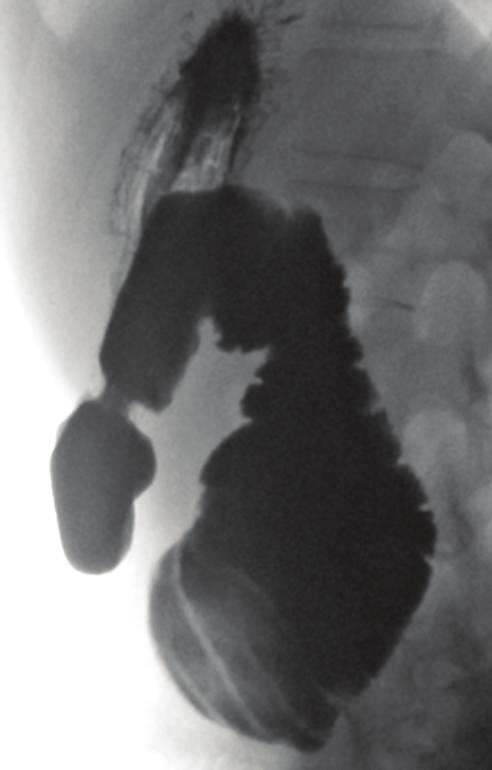 Case Reports in Surgery 3 Stomach Dilated D3 Figure 5: Lateral view of contrast study demonstrating dilated D3.