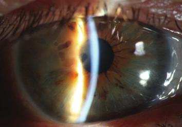 2 Case Reports in Medicine (a) (b) (c) Figure 1: (a) Case 1: slit lamp biomicroscopy picture of the right eye before CXL.
