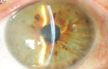 At postoperative month 1, there was 1 Snellen line improvement of vision in each eye, and although at slit lamp biomicroscopy macrobullae were present in both eyes, the CCT decreased by about 100 μm