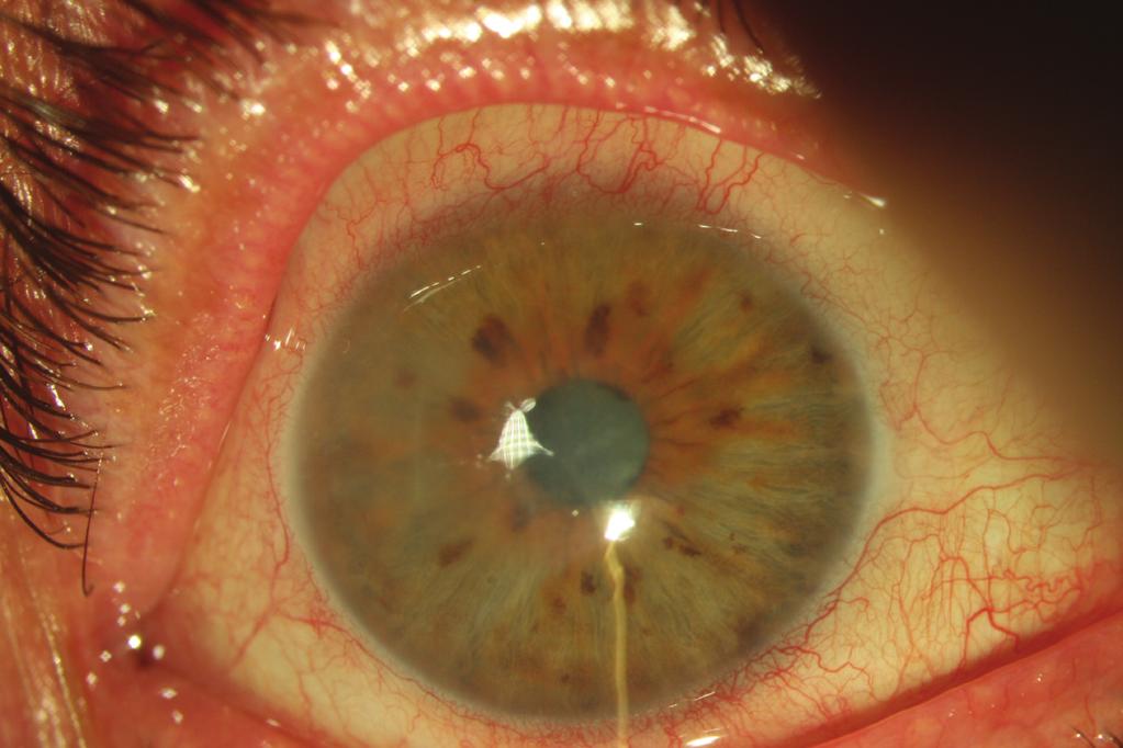 The visual acuity and CCT deteriorated back to preoperative levels by postoperative month 3 in both eyes and remained stable until postoperative month 12.