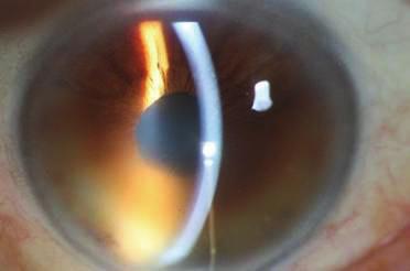 Case Reports in Medicine 3 (a) (b) (c) Figure 2: (a) Case 2: slit lamp biomicroscopy picture of the right eye before CXL.