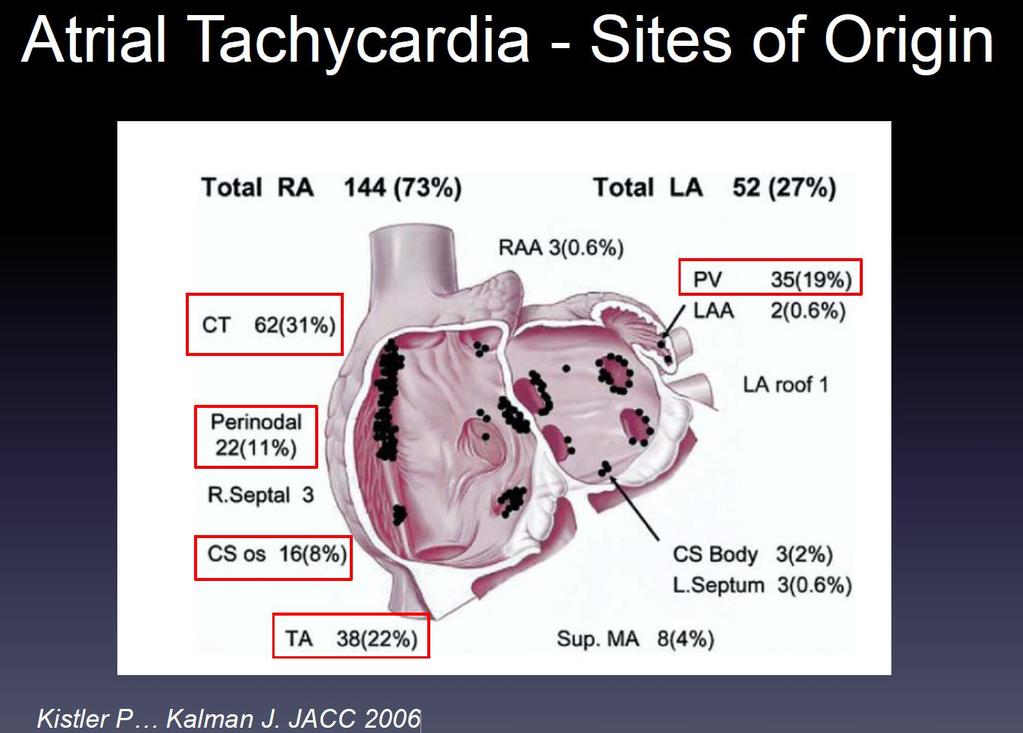 Atrial tachycardia Distinction from atrial flutter: -Focal ( Focal is Not a Mechanism) AT Mechanisms: