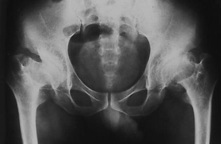 Orthopedic Problems Limb deformity LCP-like