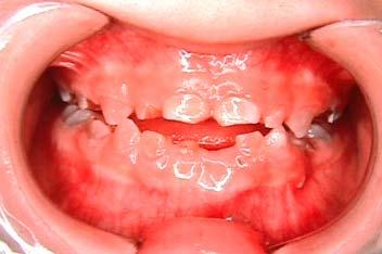 Clinical Manifestation Dentinogenesis imperfecta soft, translucent, brownish