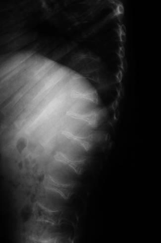 Radiologic Findings Generalized osteopenia Trefoil