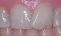 Contouring vs. Orthodontics Photo 1 Maxillary central incisors are overlapped.