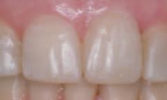 Photo 2 Maxillary central incisors after six months of orthodontic treatment.
