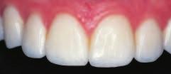 Contouring to Soften Smile Photo 7 Patient with porcelain veneers wants smile softened.