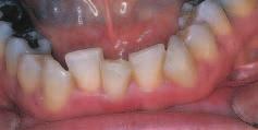 Contouring to Create Illusion of Straightness Photo 9 Direct frontal view of mandibular anteriors suggests only the right lateral incisor is misaligned.