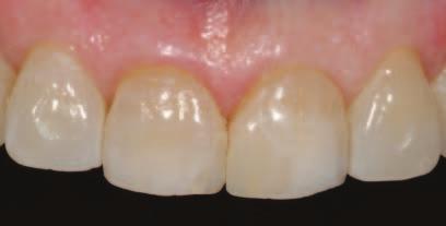 Note that, due to the contouring procedures, the tooth itself has become somewhat desiccated, creating a shade