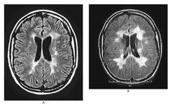 MS Clinical Evaluation Diagnosis: Dissemination of time and space Performance of activities MRI evaluation CSF: Oligoclonal banding Multiple Sclerosis