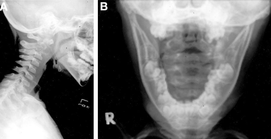 AJNR: 25, June/July 2004 FATAL ETHIBLOC EMBOLIZATION 1117 FIG 1. Lateral (A) and open-mouth odontoid (B) conventional radiographs of the cervical spine show the osteodestructive lesion in C2.