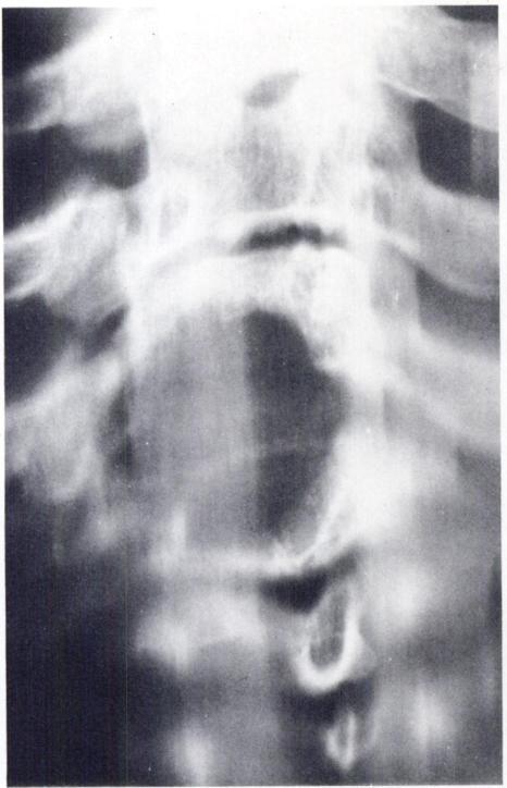ANEURYSMAL BONE CYST OF THE SPINE 529 become tetraplegic, then underwent posterior decompression without biopsy in another hospital, but died in the immediate postoperative period.