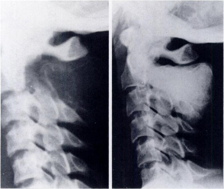 ANEURYSMAL BONE CYST OF THE SPINE 531 Ftc.. 5-A FIG. 5-B Figs. 5-A and 5-B: A fifteen-year-old patient. Fig. 5-A: There is an aneurysmal bone cyst in the posterior elements of the second cervical vertebra.