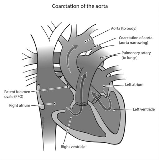 org/en/health-topics/congenital-heart-defects/about-congenital-heart-defects/patent-ductus-arteriosus-pda Coarctation of Aorta Familial