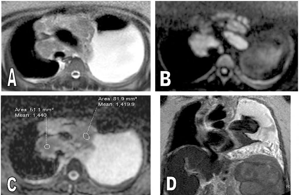 928 Role of MRI Diffusion in Assessment of Mediastinal Lymphadenopathy MRI findings in cases with lymphoma and sarcoidosis: Our study involved the evaluation of 13 patients (6 males & 7 females) with