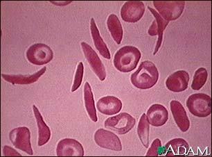 Sickle Cell Anemia Sickle-cell anemia is a dangerous, usually fatal genetic disorder. Red blood cells carry OXYGEN through your body.
