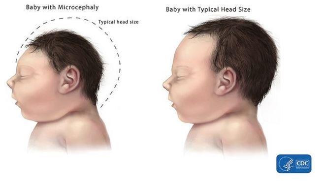A virus that: Causes microcephaly (improper brain development in fetuses).