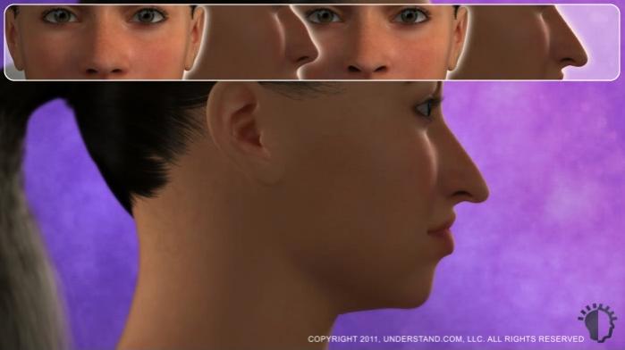 Introduction Are you interested in improving the appearance of your nose? If so, you re not alone. Nose reshaping, or rhinoplasty, is one of the most common plastic surgery procedures performed today.