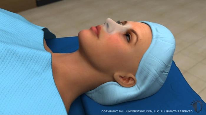 Preparation Rhinoplasty surgery may be performed under general anesthesia, which causes you to sleep during the procedure.