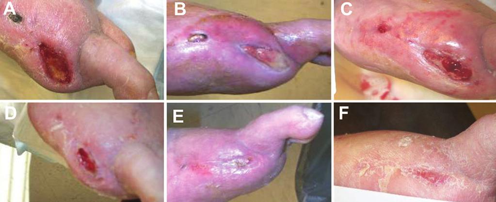 116 Figure 1: Use of fish-skin derived skin-substitute and SNAP System in a diabetic foot ulcer. A. Wound at presentation; B. Wound after seven days of therapy; C. Wound after 14 days of therapy; D.