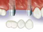 32 Restorative options with s s are manufactured from titanium alloy and used as the support foundation for single- or multiple-unit cement-retained, partially edentulous