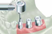 Note: The abutment should have the same profile as the Healing Collar and Direct or Indirect Transfer. For the AdVent Implant with the 4.5mmD, the Indirect Transfer [AVIT/4] is used for both the 4.