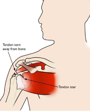 Shoulder Arthroscopic Rotator Cuff Repair FAQ Ryan W. Hess, MD Office: 763-302-2223 Fax: 763-302-2402 Twitter: RyanHessMD Q: WHAT IS ACCOMPLISHED DURING THE PROCEDURE?