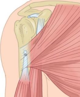 o Biceps tenodesis- This is a similar procedure to biceps tenotomy, but the tendon is attached to the arm bone at the front of the shoulder with an anchor(s).