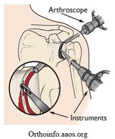 Hess peforms a tenodesis in younger, active patients and tenotomy in older, less active patients.