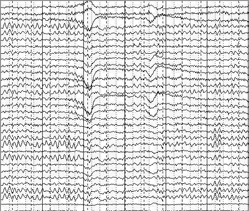 (K complexes, spindles) EEG Report or Interpretation Description of Paroxysmal Discharges Morphology (spike, sharp wave, spike & wave) Topography