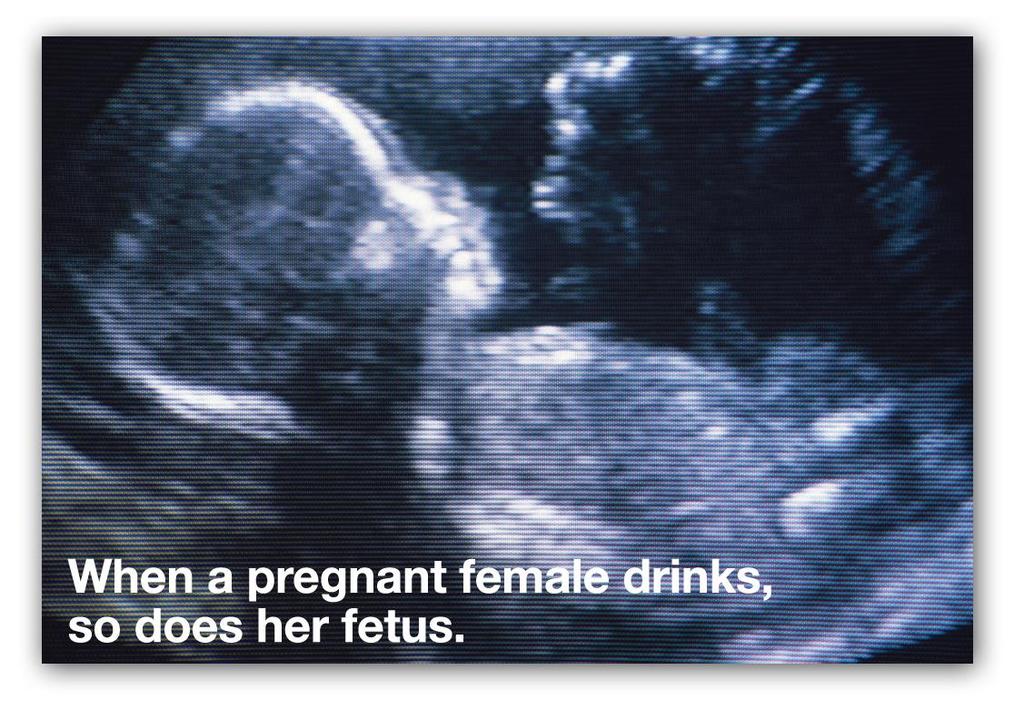 Group of alcohol-related birth defects that include physical & mental problems FETAL ALCOHOL SYNDROME Effects of FAS: -Heart, liver & kidney defects -Vision & hearing problems -Developmental