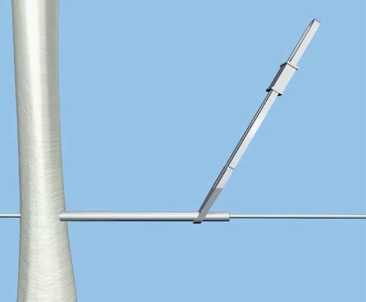 Insert a smooth wire near the joint that is furthest from the injury site, perpendicular to the long axis of the bone and parallel to the joint.