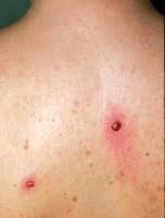 Case 2 A Mediterranean Matter A 62-year-old, Mediterranean male with hypertension, who is otherwise healthy, presents with several red-blue papules on his upper back.