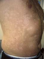 Case 5 It s spreading! A 34-year-old male presents with a one-year history of a spreading, hypopigmented eruption that began on his back and now involves much of his trunk.