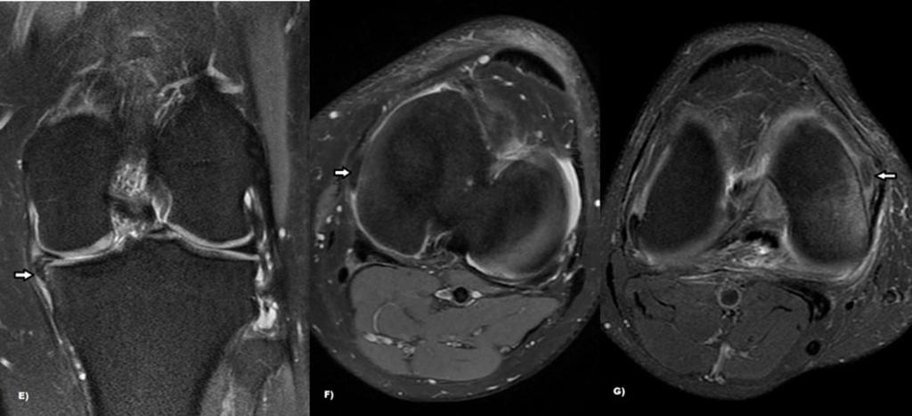 Fig. 5: Horizontal flap tear: Axial and sagittal PD FS MR show displaced fragments in the recesses of the body of the meniscus.