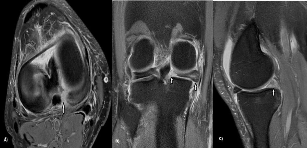 Radiologia, hospital universitario de burgos - Burgos/ES Fig. 6: Radial tear with truncation of the posterior root of the medial meniscus.