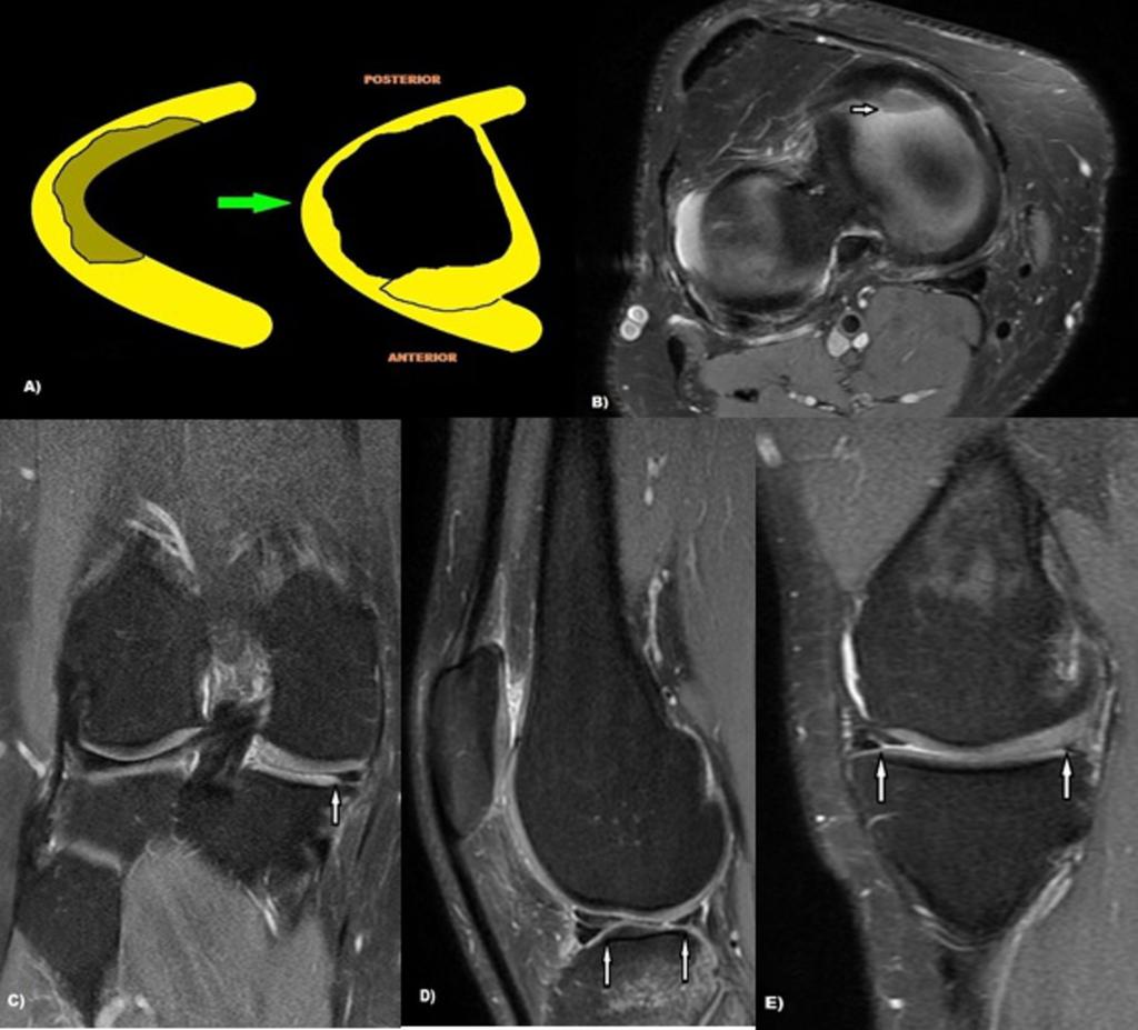 Fig. 2: Flipped meniscus: Graphic, axial, coronal and sagittal PD FS MR show a lateral flipped meniscus.