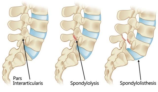 Stress Fractures of the Lumbar Vertebrae Stress fractures result from repeated local stress on one area of the bone. The healing process may be unable to keep up with the rate of injury.