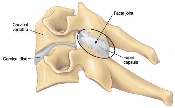 Facet Joint Sprains Facet joints are small synovial joints between the vertebra. Generally sprained do to uncontrolled movements. Commonly injured landing from a jump.