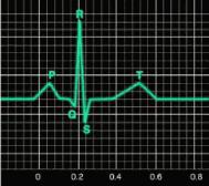 Electrocardiogram (ECG) Diagram used to illustrate electrical activity in the heart Measures voltage