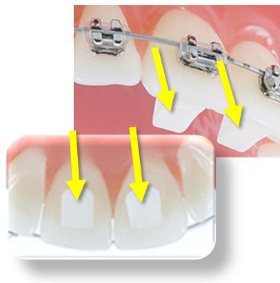 Remove calculus and any other material that will misrepresent the true shape of the teeth.