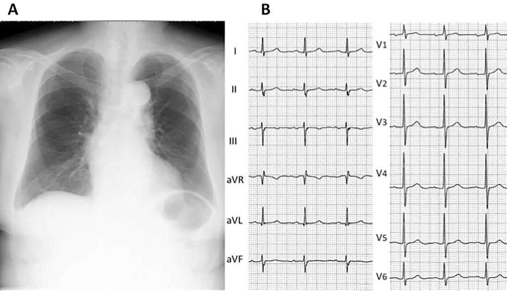 Figure 1. The chest X-ray upon admission. A: The chest X ray film showed normal lungs and a normal cardiac silhouette.