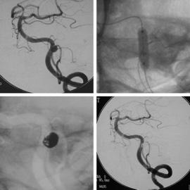 Fig. 2 A 64-year-old man presented with sudden headache and dysarthria. A: Left vertebral angiogram showing an aneurysmal dilatation with intimal flap.