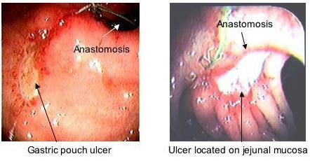 Marginal Ulcers One of the most common complications after RYGB 0.