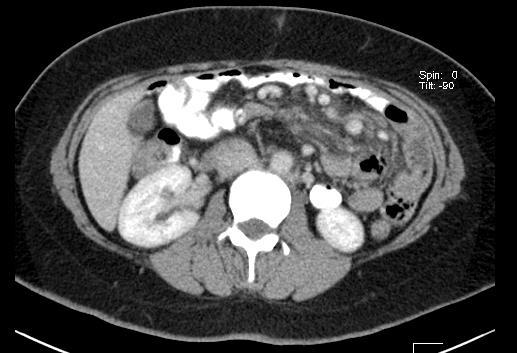 anastomotic ulcer, No obstruction CT Scan Non specific changes.