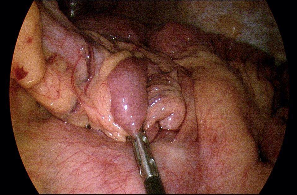 Diagnostic Laparoscopy Transverse colon Long length